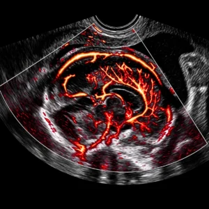 Fetal Neurosonography
