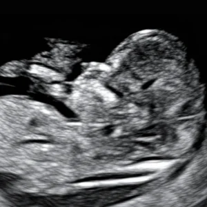 Nuchal Translucency (NT) Scan
