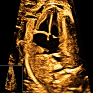 Fetal Echocardiography