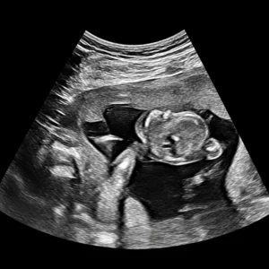 Amniocentesis