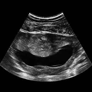Chorionic Villus Sampling