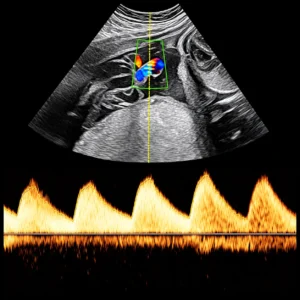 Fetal Doppler Studies