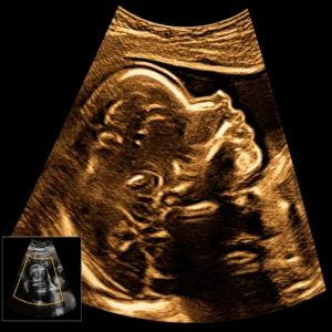 Mid-Trimester Anomaly scan