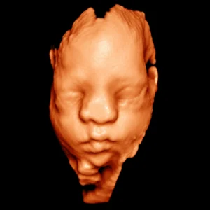 3D/4D Ultrasound