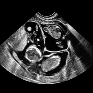 Multi fetal Reduction.